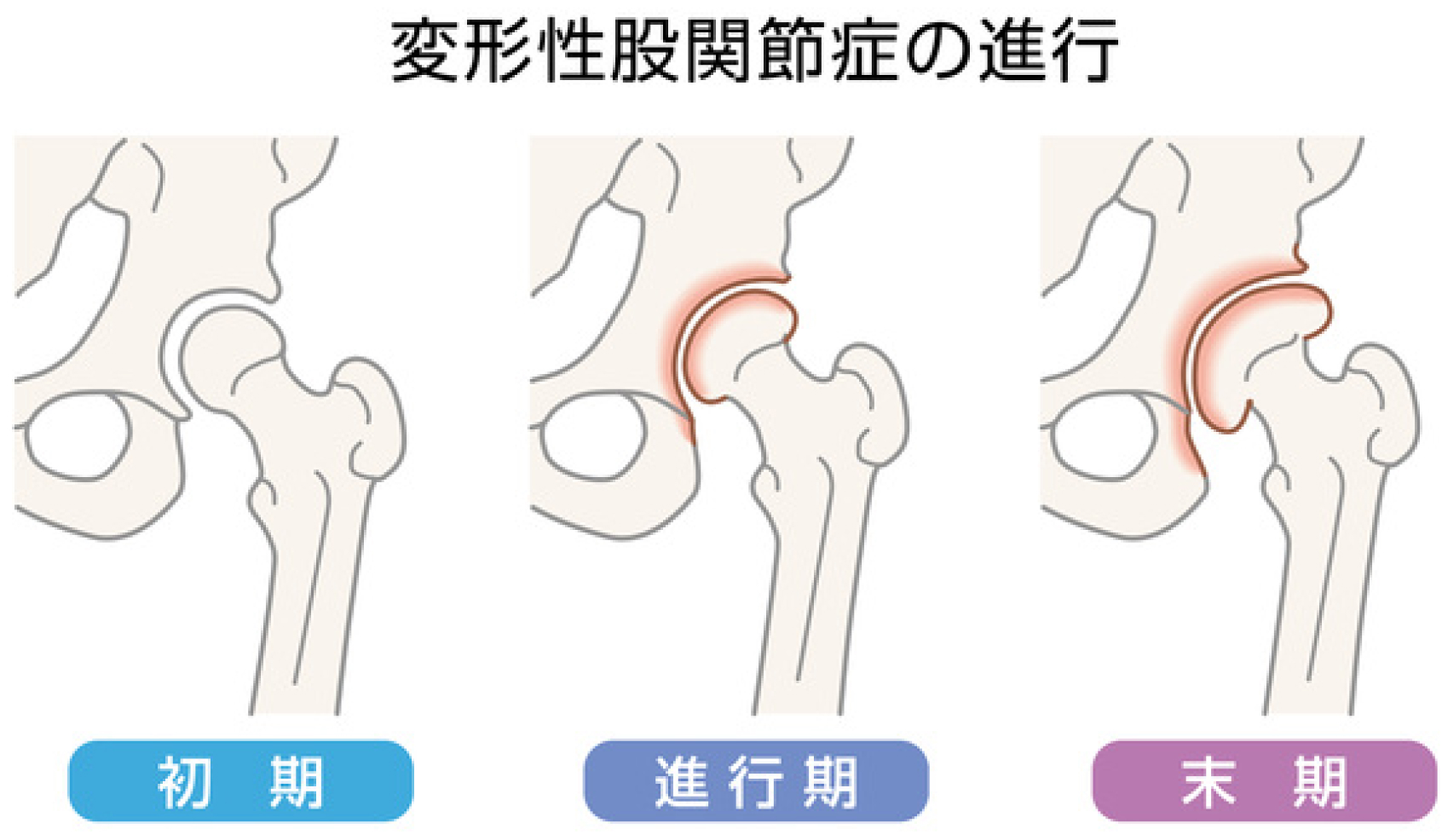 変形性股関節症 イメージ図