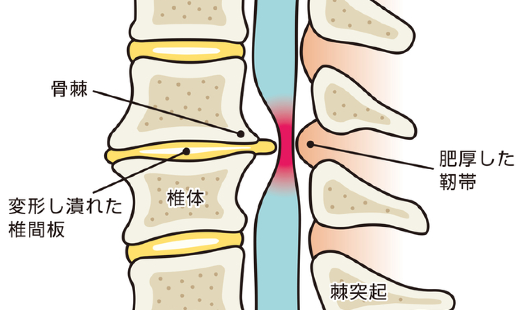 変形性股関節症 イメージ図