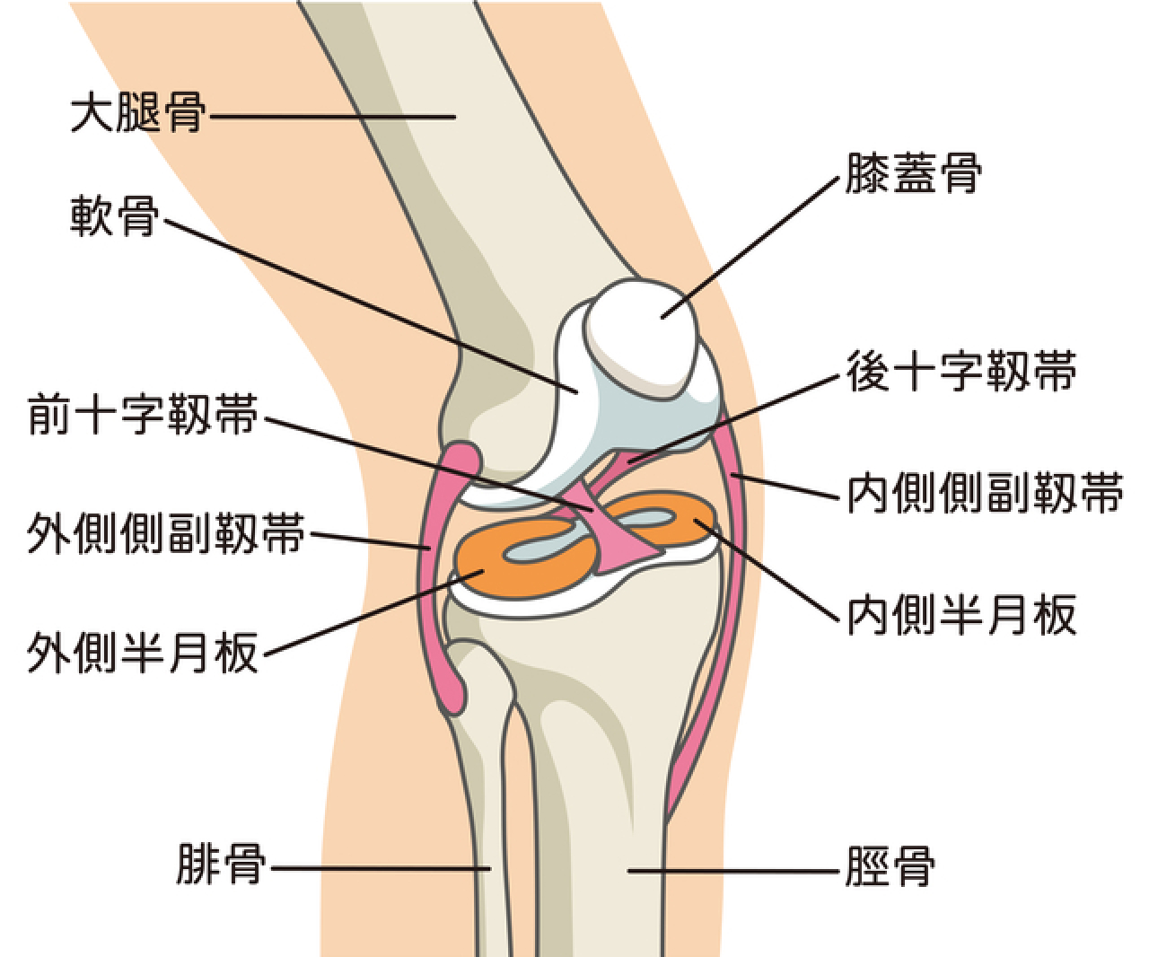 半月板損傷 イメージ図