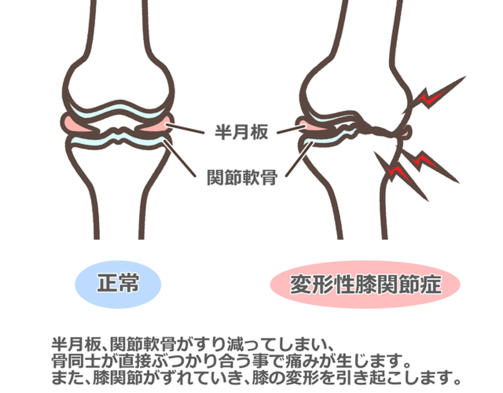 変形性膝関節症 イメージ図